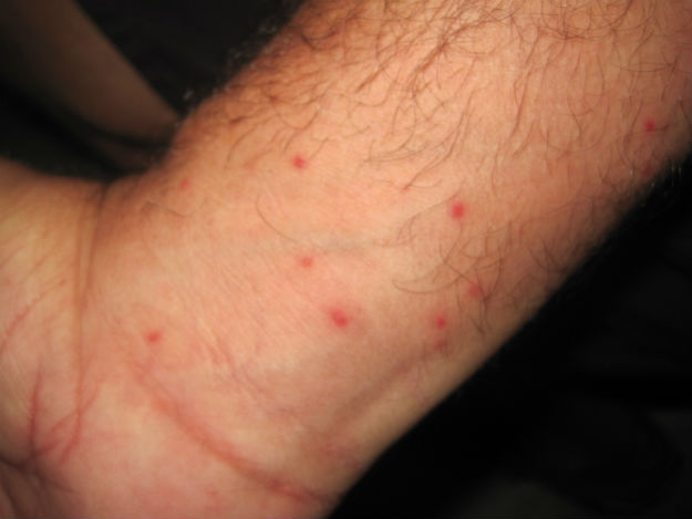 mosquito bites wrist